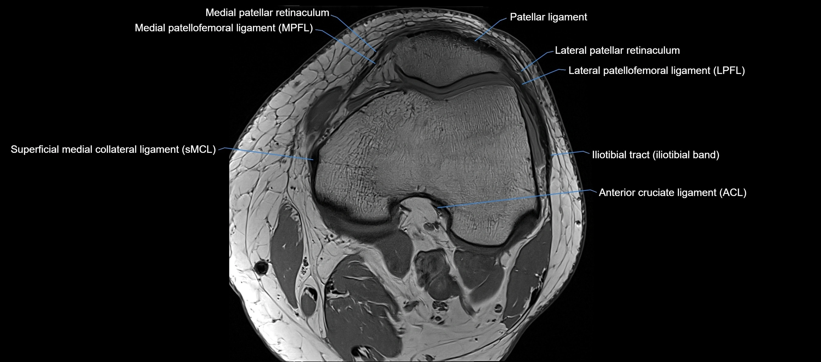 MRI Knee axial  ligaments cross sectional anatomy 3T  radiology  image-img-03001-00017.webp
